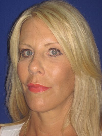 Facelift/Mini-Facelift Before & After Gallery - Patient 4889843 - Image 6