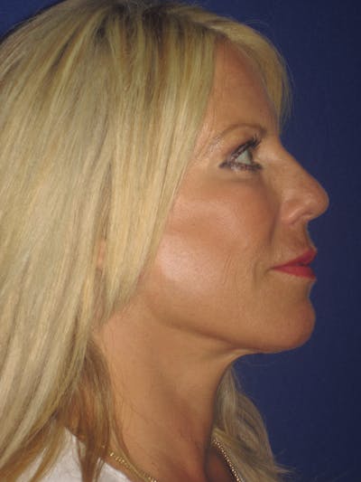 Facelift/Mini-Facelift Before & After Gallery - Patient 4889843 - Image 8