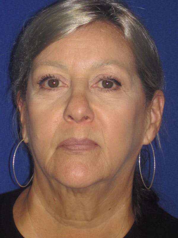 Facelift/Mini-Facelift Before & After Gallery - Patient 4890133 - Image 3