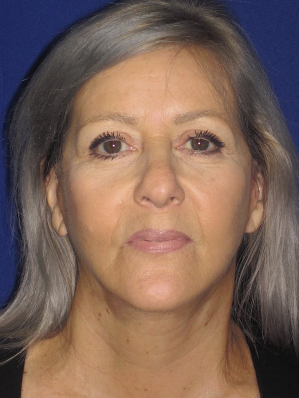 Facelift/Mini-Facelift Before & After Gallery - Patient 4890133 - Image 4