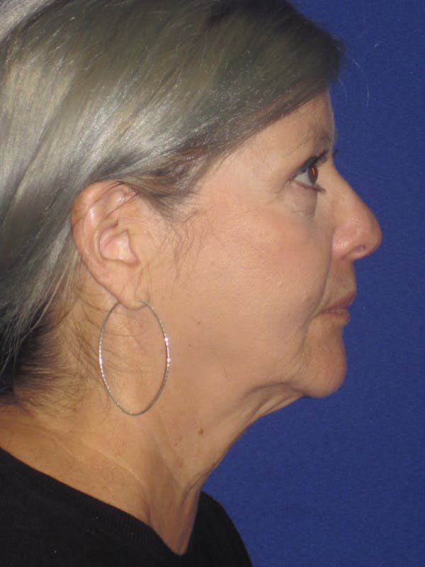 Facelift/Mini-Facelift Before & After Gallery - Patient 4890133 - Image 5