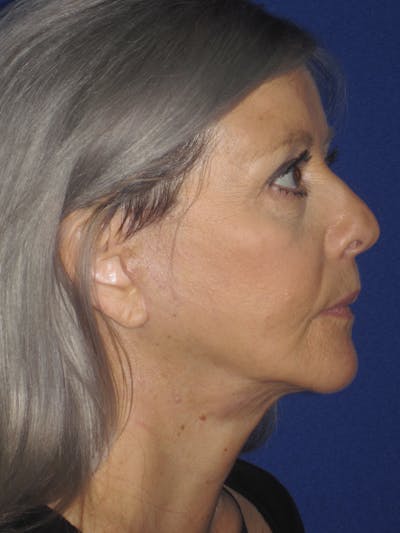 Facelift/Mini-Facelift Before & After Gallery - Patient 4890133 - Image 6
