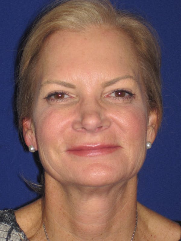 Facelift/Mini-Facelift Before & After Gallery - Patient 4890352 - Image 1