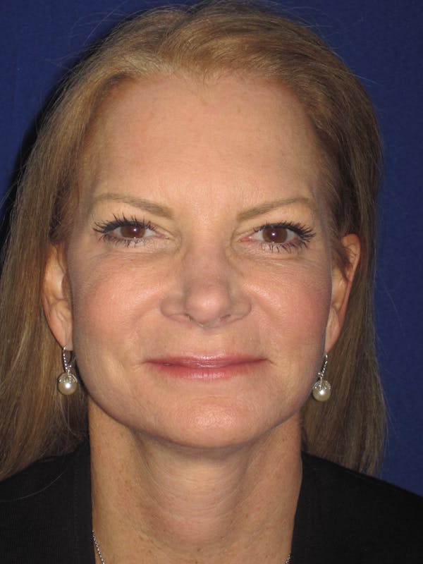 Facelift/Mini-Facelift Before & After Gallery - Patient 4890352 - Image 2
