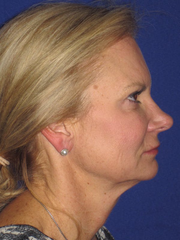 Facelift/Mini-Facelift Before & After Gallery - Patient 4890352 - Image 3
