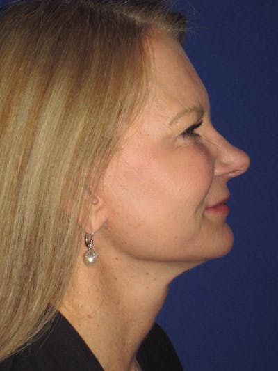 Facelift/Mini-Facelift Before & After Gallery - Patient 4890352 - Image 4
