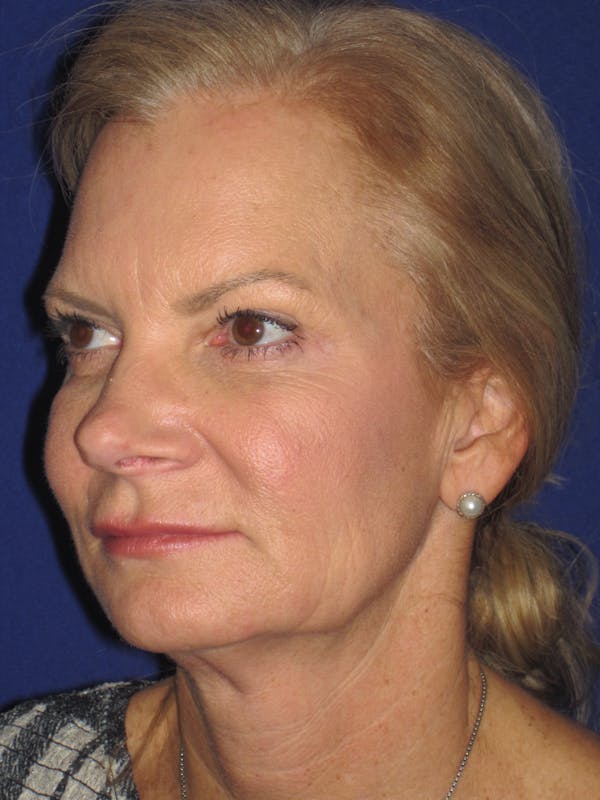 Facelift/Mini-Facelift Before & After Gallery - Patient 4890352 - Image 5