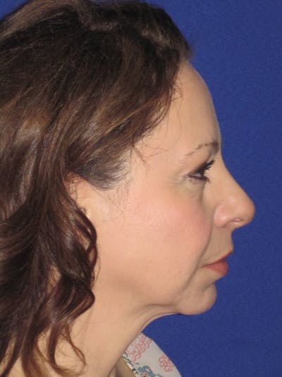 Facelift/Mini-Facelift Before & After Gallery - Patient 4890357 - Image 1