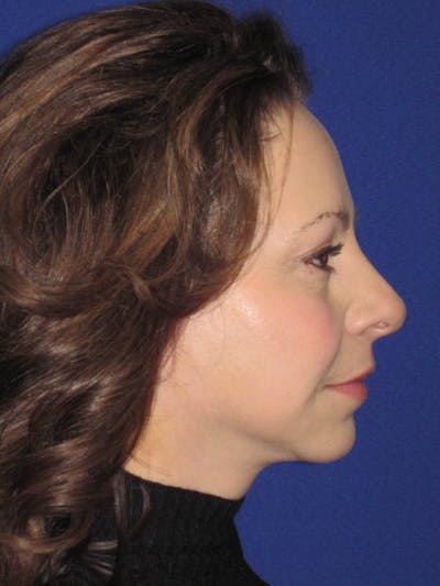 Facelift/Mini-Facelift Before & After Gallery - Patient 4890357 - Image 2