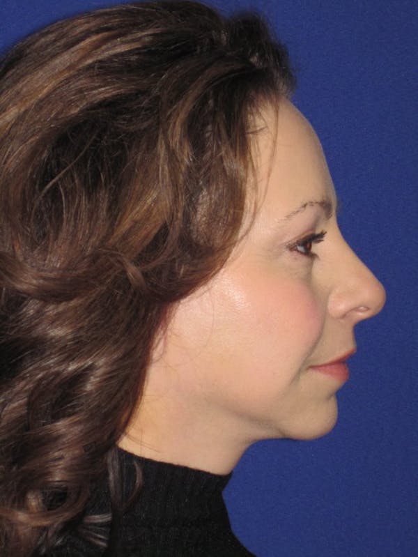 Facelift/Mini-Facelift Before & After Gallery - Patient 4890357 - Image 2