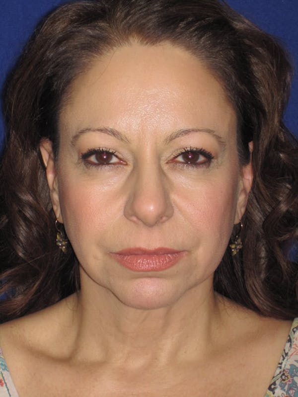 Facelift/Mini-Facelift Before & After Gallery - Patient 4890357 - Image 5