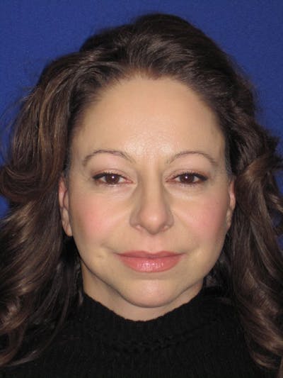 Facelift/Mini-Facelift Before & After Gallery - Patient 4890357 - Image 6