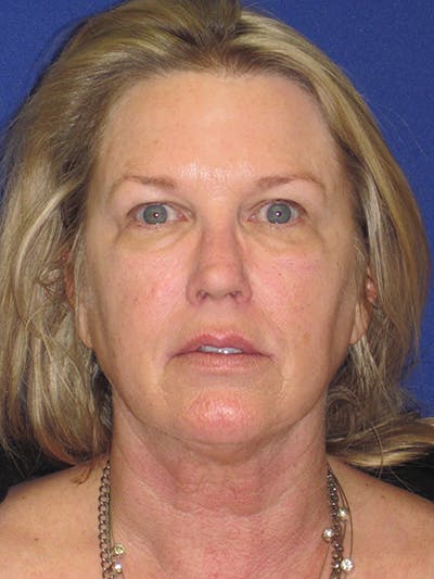 Facelift/Mini-Facelift Before & After Gallery - Patient 4890362 - Image 1