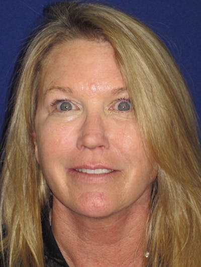 Facelift/Mini-Facelift Before & After Gallery - Patient 4890362 - Image 2