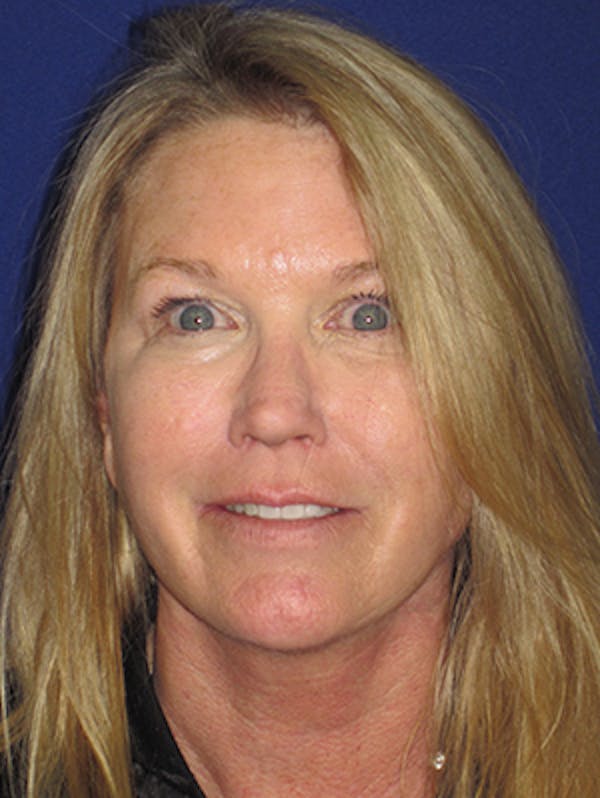 Facelift/Mini-Facelift Before & After Gallery - Patient 4890362 - Image 2