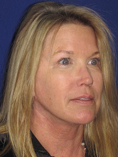 Facelift/Mini-Facelift Before & After Gallery - Patient 4890362 - Image 4