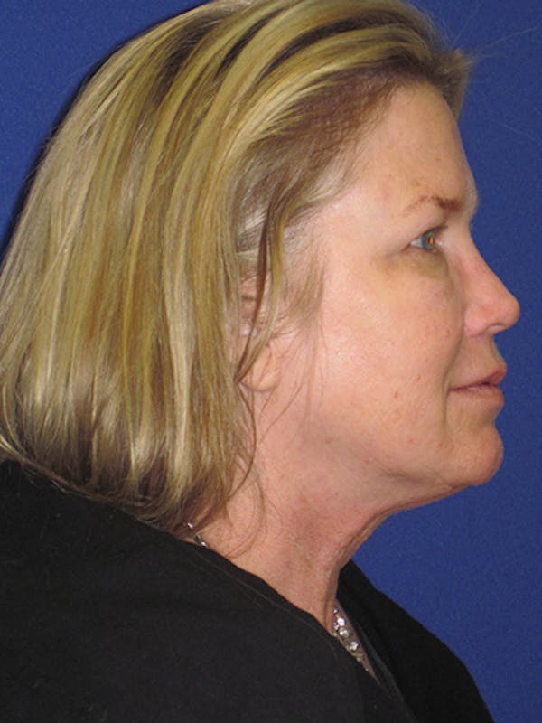 Facelift/Mini-Facelift Before & After Gallery - Patient 4890362 - Image 5