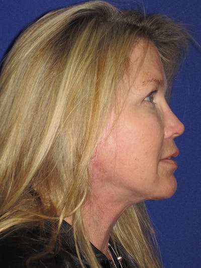 Facelift/Mini-Facelift Before & After Gallery - Patient 4890362 - Image 6