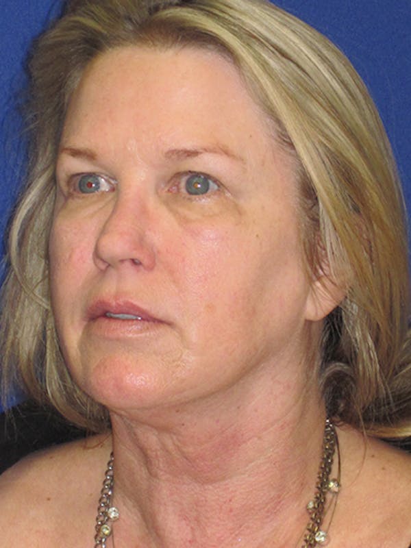 Facelift/Mini-Facelift Before & After Gallery - Patient 4890362 - Image 7