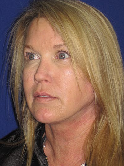 Facelift/Mini-Facelift Before & After Gallery - Patient 4890362 - Image 8