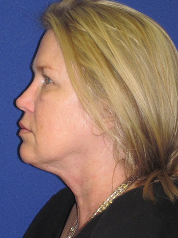 Facelift/Mini-Facelift Before & After Gallery - Patient 4890362 - Image 9