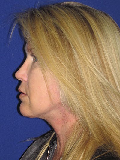 Facelift/Mini-Facelift Before & After Gallery - Patient 4890362 - Image 10