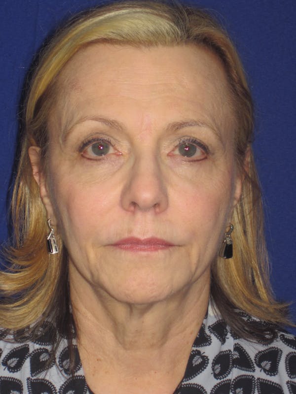 Facelift/Mini-Facelift Before & After Gallery - Patient 4890380 - Image 1
