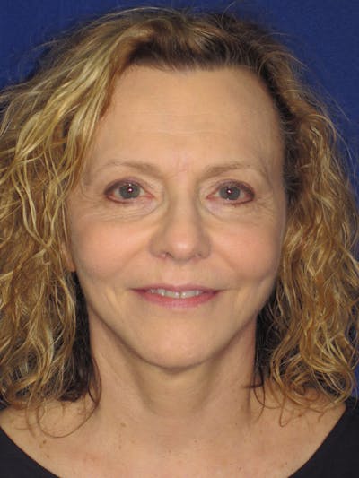 Facelift/Mini-Facelift Before & After Gallery - Patient 4890380 - Image 2