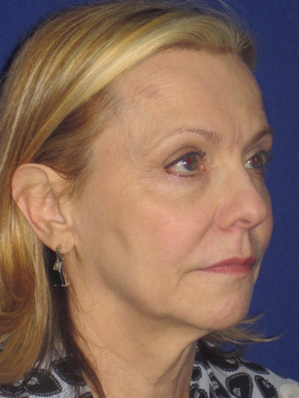 Facelift/Mini-Facelift Before & After Gallery - Patient 4890380 - Image 3