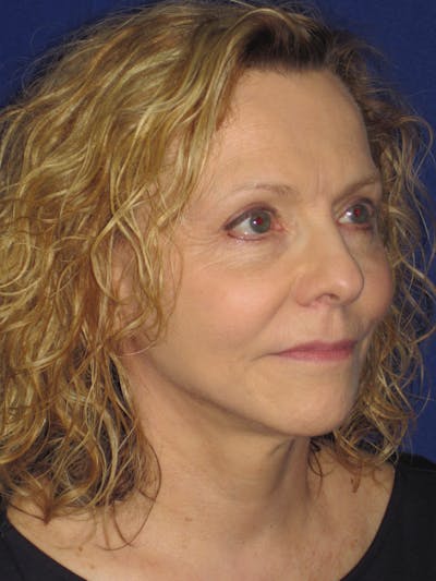 Facelift/Mini-Facelift Before & After Gallery - Patient 4890380 - Image 4