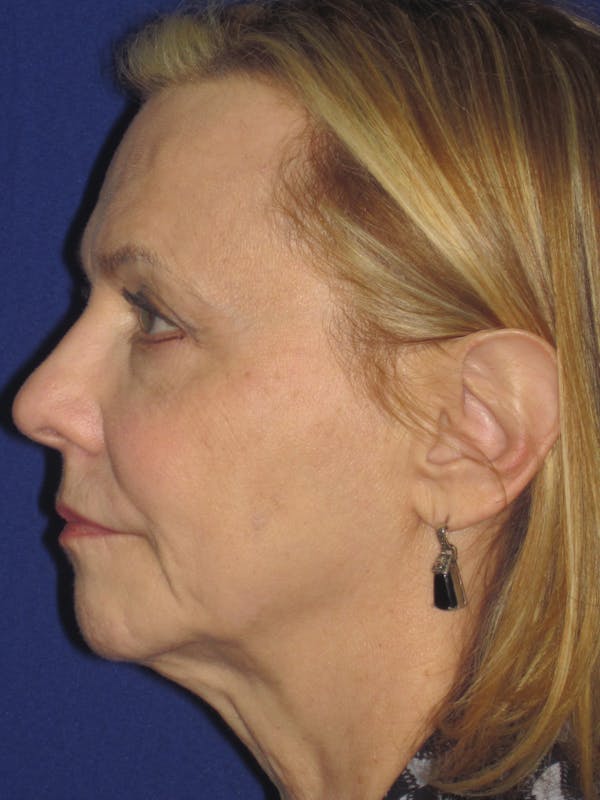 Facelift/Mini-Facelift Before & After Gallery - Patient 4890380 - Image 5