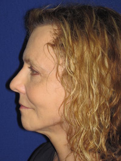 Facelift/Mini-Facelift Before & After Gallery - Patient 4890380 - Image 6