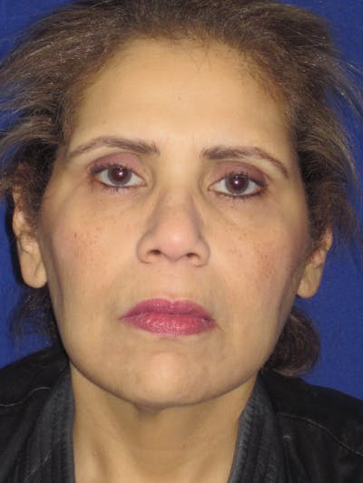 Facelift/Mini-Facelift Before & After Gallery - Patient 4890390 - Image 1