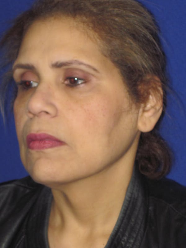 Facelift/Mini-Facelift Before & After Gallery - Patient 4890390 - Image 3