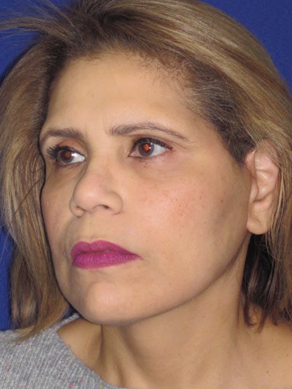Facelift/Mini-Facelift Before & After Gallery - Patient 4890390 - Image 4