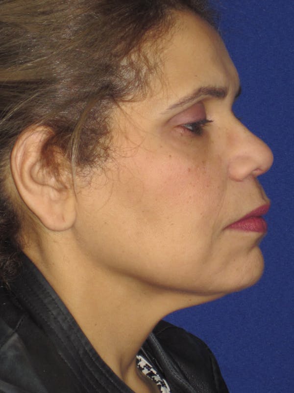 Facelift/Mini-Facelift Before & After Gallery - Patient 4890390 - Image 5