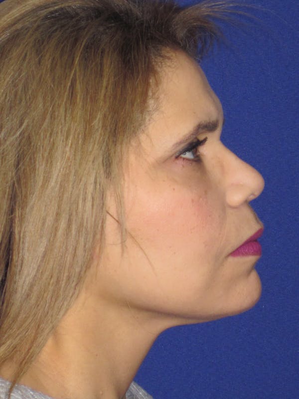 Facelift/Mini-Facelift Before & After Gallery - Patient 4890390 - Image 6