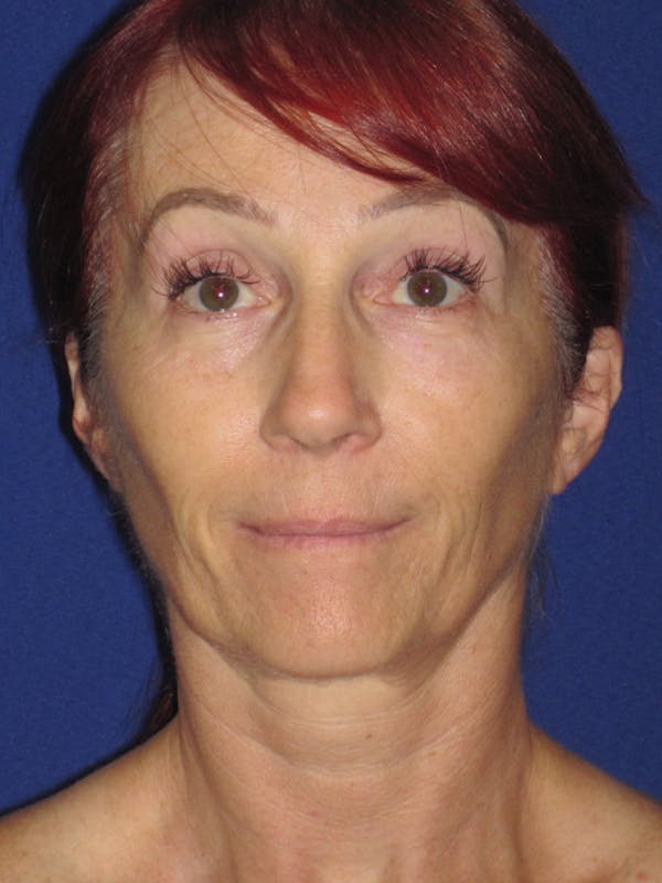 Facelift/Mini-Facelift Before & After Gallery - Patient 4890399 - Image 1