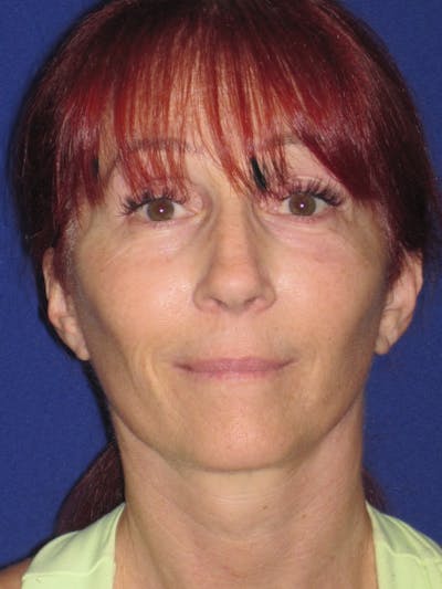 Facelift/Mini-Facelift Before & After Gallery - Patient 4890399 - Image 2