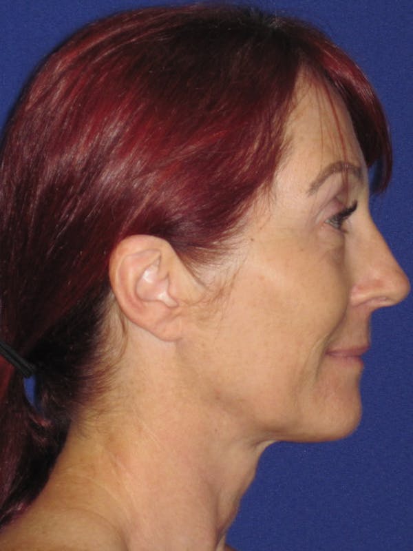Facelift/Mini-Facelift Before & After Gallery - Patient 4890399 - Image 3