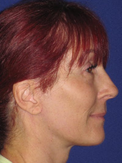 Facelift/Mini-Facelift Before & After Gallery - Patient 4890399 - Image 4
