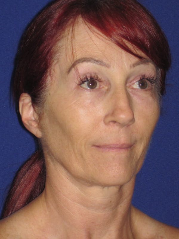 Facelift/Mini-Facelift Before & After Gallery - Patient 4890399 - Image 5