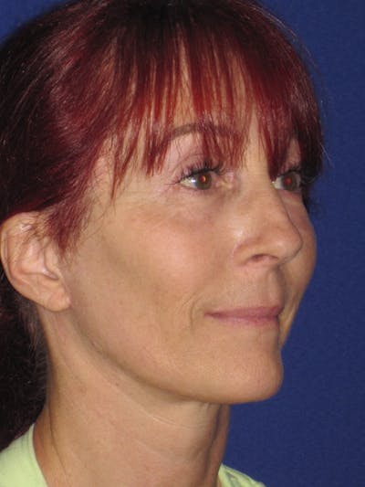 Facelift/Mini-Facelift Before & After Gallery - Patient 4890399 - Image 6
