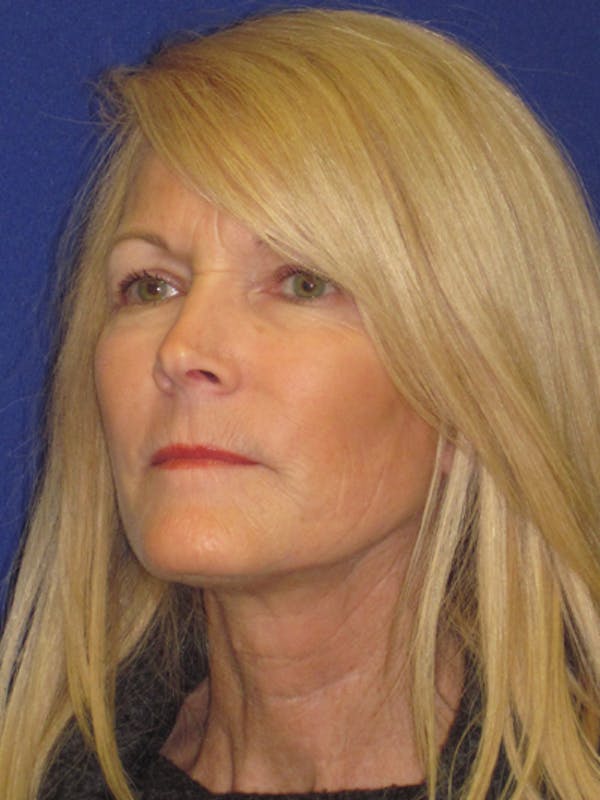 Facelift/Mini-Facelift Before & After Gallery - Patient 4890406 - Image 2