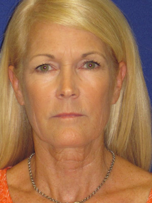 Facelift/Mini-Facelift Before & After Gallery - Patient 4890406 - Image 3