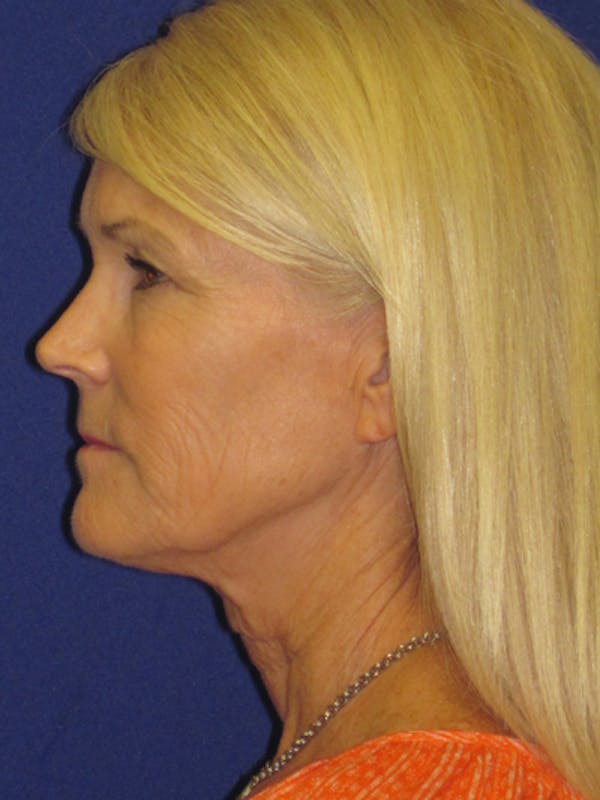 Facelift/Mini-Facelift Before & After Gallery - Patient 4890406 - Image 5