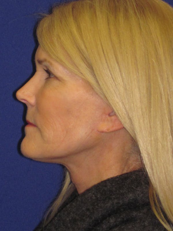 Facelift/Mini-Facelift Before & After Gallery - Patient 4890406 - Image 6