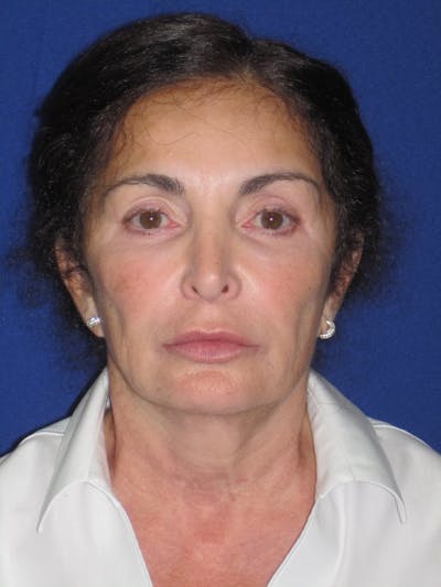 Facelift/Mini-Facelift Before & After Gallery - Patient 4890410 - Image 1