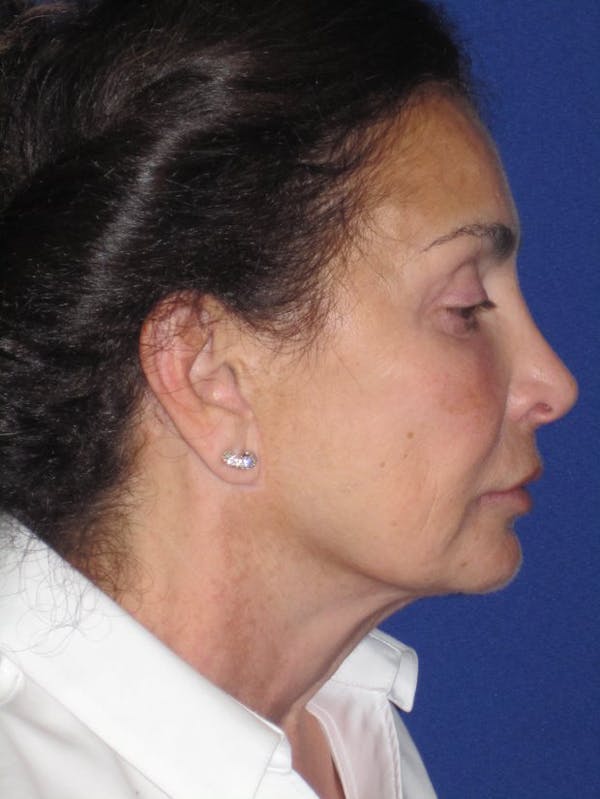 Facelift/Mini-Facelift Before & After Gallery - Patient 4890410 - Image 3