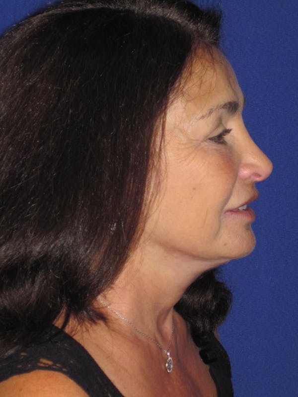 Facelift/Mini-Facelift Before & After Gallery - Patient 4890410 - Image 4